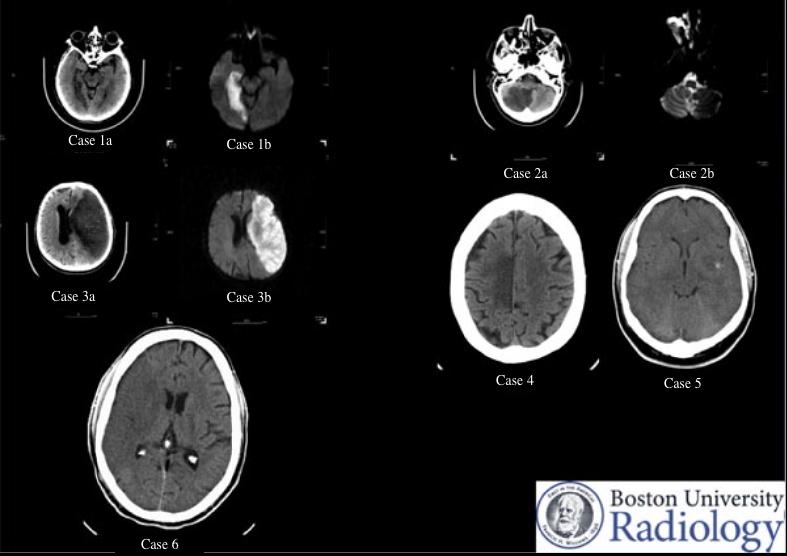 cerebralvascposter