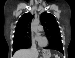 corChestCT