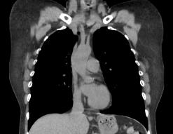 corChestCT