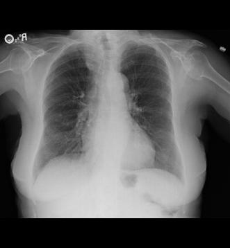 CXR1