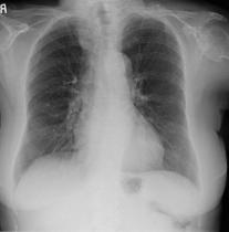 CXR1