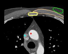 cardiaclabax