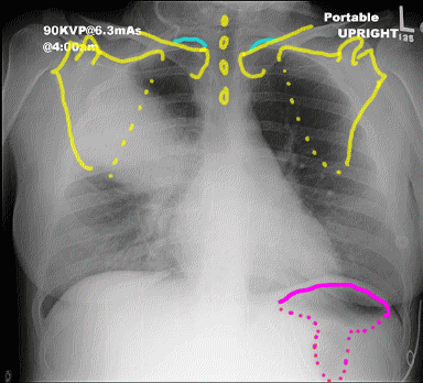 case3scapandrotat