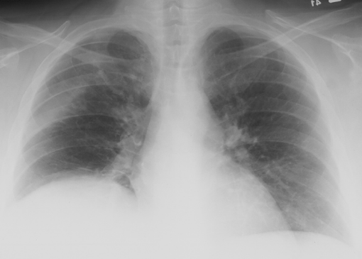 case4CXR