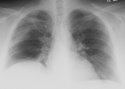 case4CXR