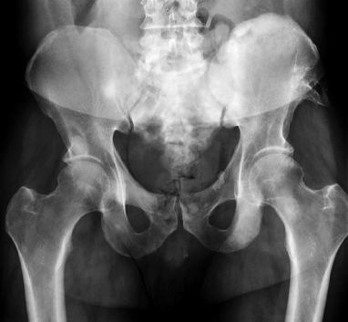 pelvis1