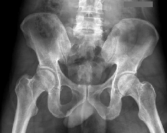 pelvis2