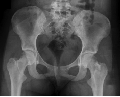 pelvis3
