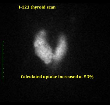 thyroidscan