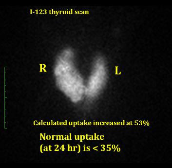 thyroidscanlab