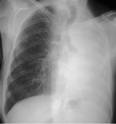 case4pt1PACXR