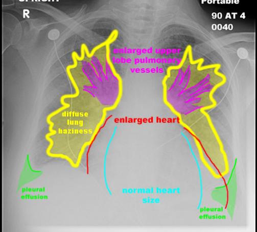 CHFportableannotated