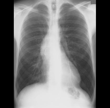 preopcxr