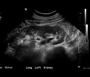 RENALULTRASOUNDnmlLeft