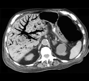 CT1