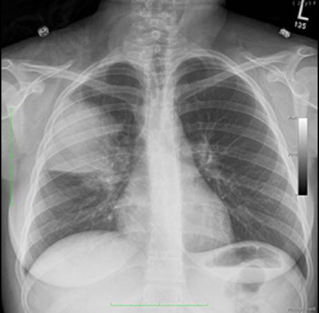 cxr1