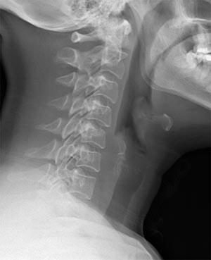 epiglottitisbkg