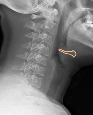 epiglottitisHyoid