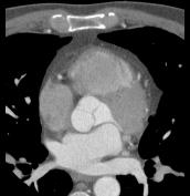 heartCT