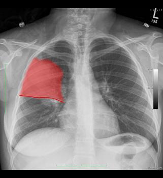 pneumonia