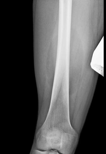 APfemur