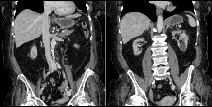 ltrtkidneys
