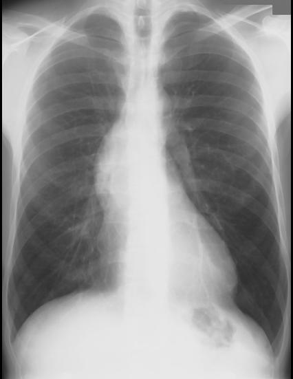 CXR