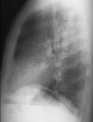 preoplatcxr