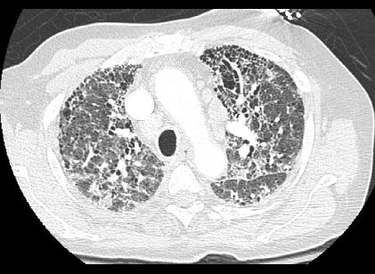 axCTfibrosis1