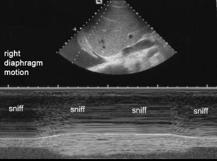 rtdiaphmotion1